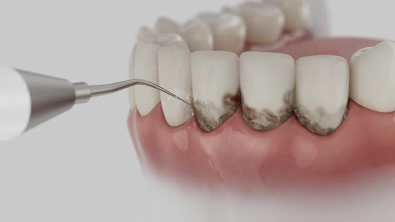 Trusted Wisdom Tooth Removal service in Fox Island, WA - Dentist Open Now
